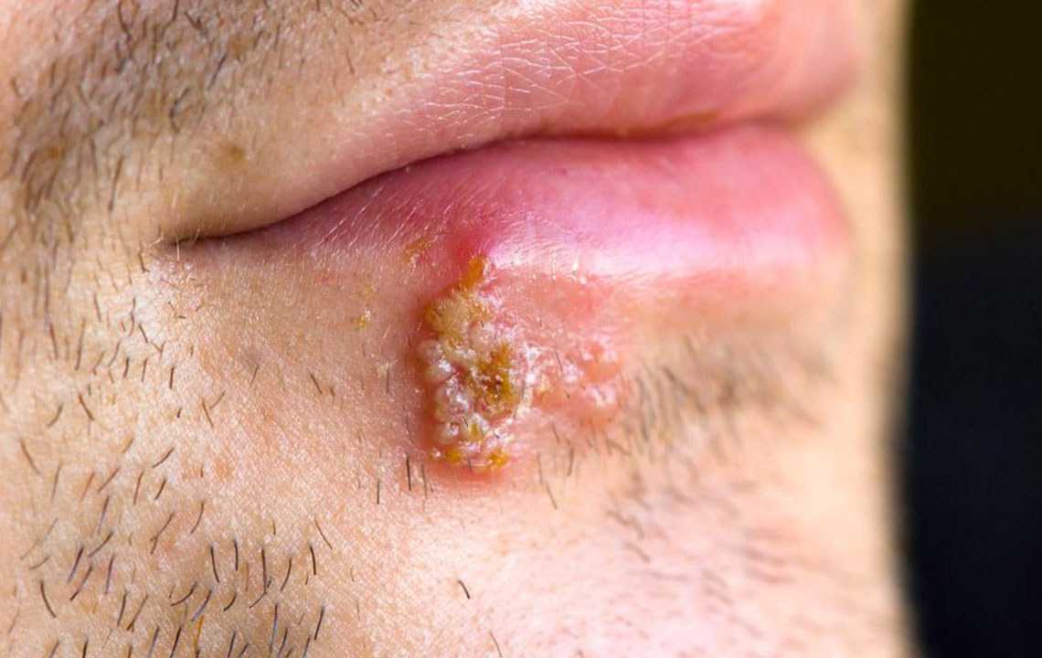 Signs that tell you might have herpes