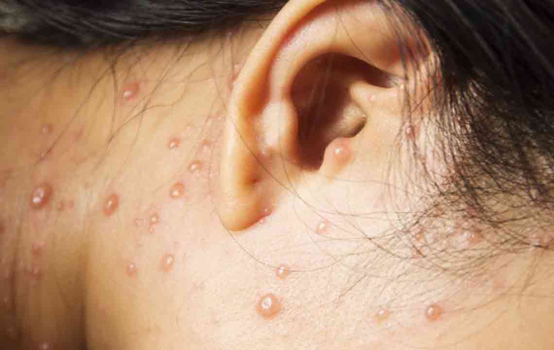 All You Need to Know About Shingles