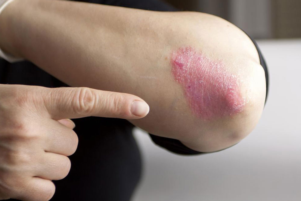 Types and Treatment of Chronic Psoriasis