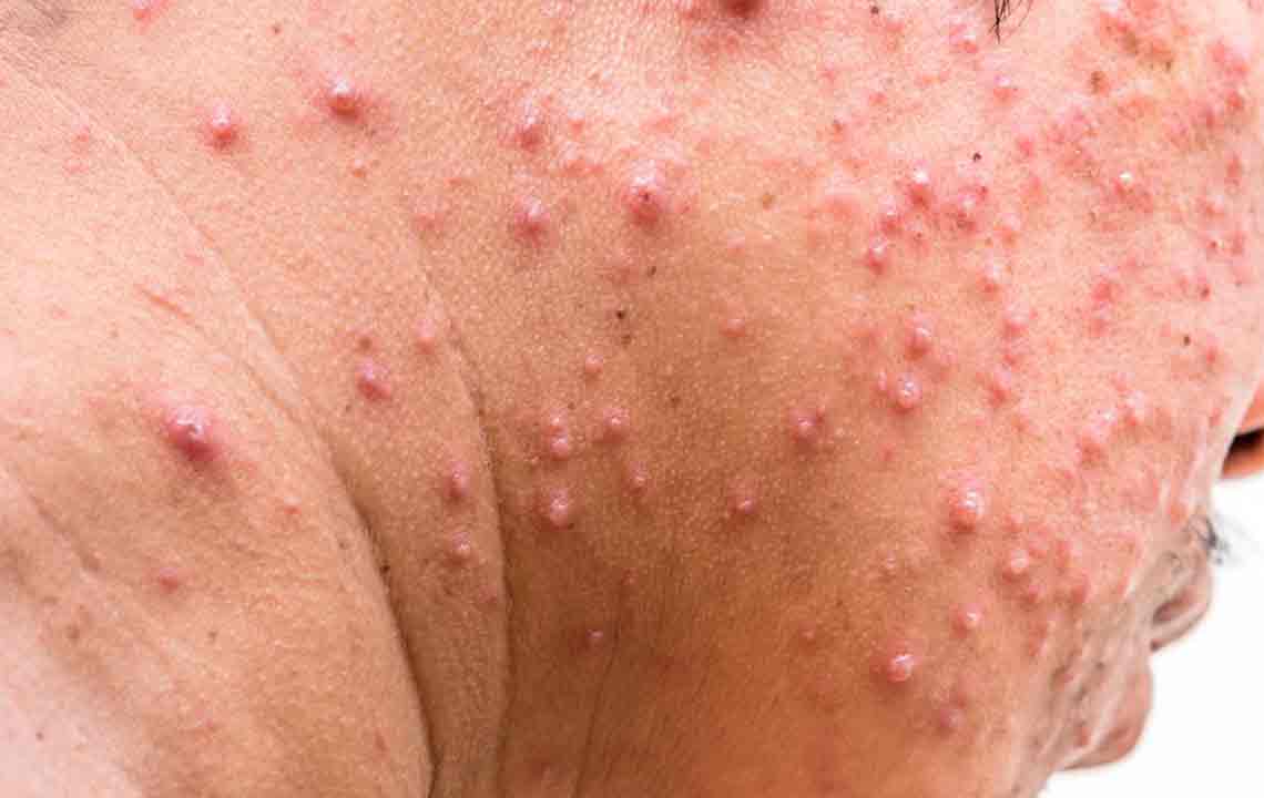 Tips to Treat Shingles Rash