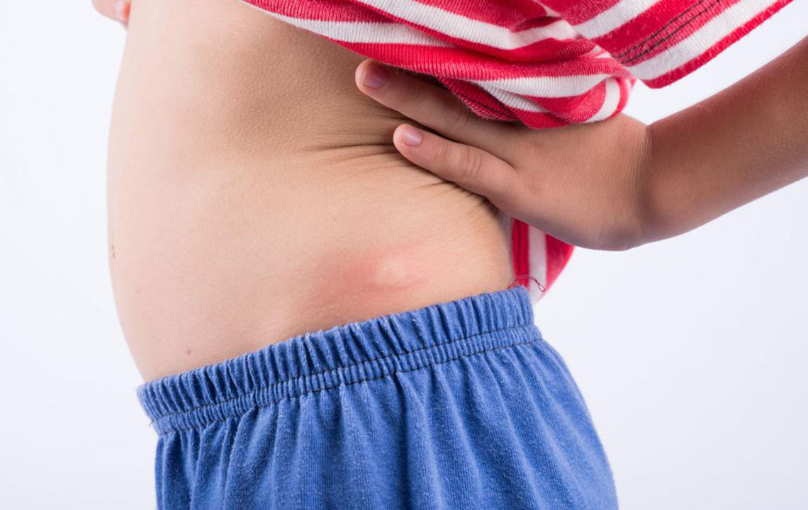 6 Daily Activities That Help In Shingles Rash Treatment